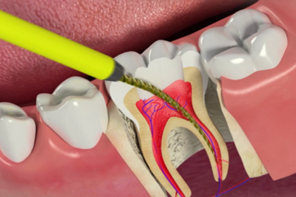 Signs of Root Canal